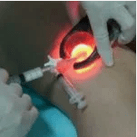 Métodos para o tratamento das varices