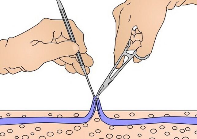 decapado de veas para varices