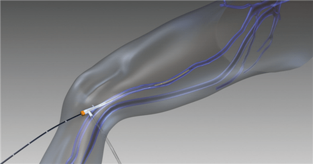 obliteración por radiofrecuencia para varices