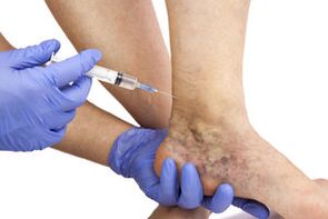 inxeccións para varices