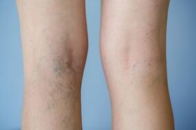 varices nas pernas
